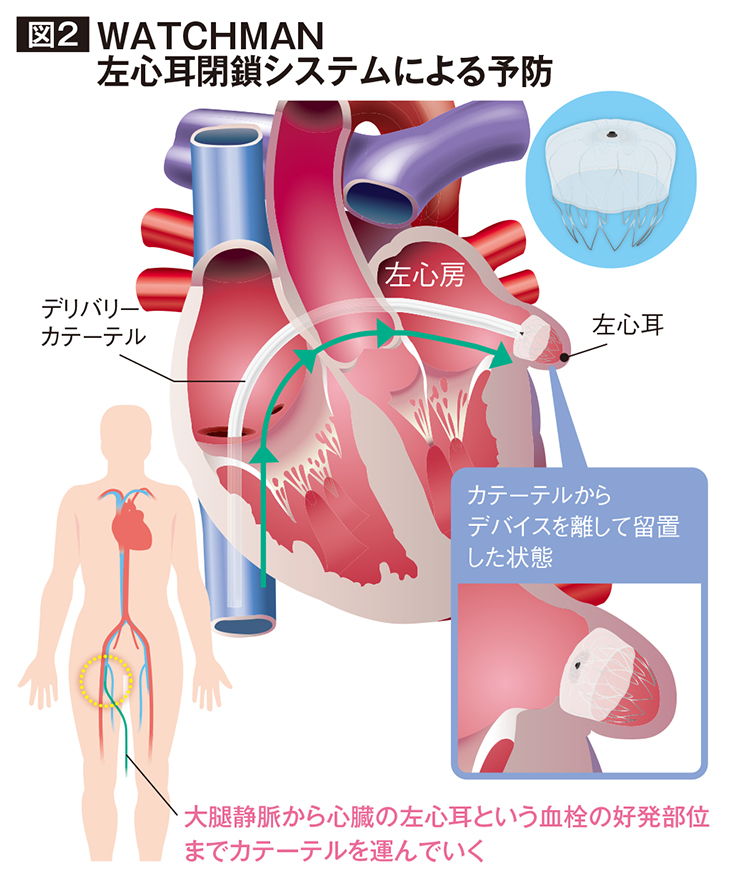 左心房の心耳