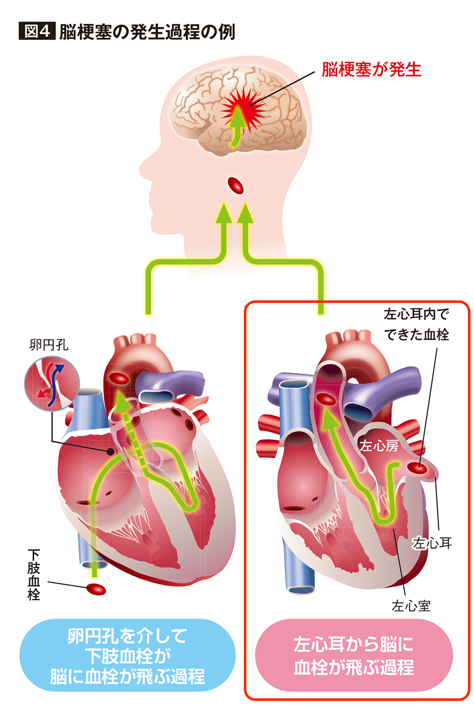 左心房の心耳